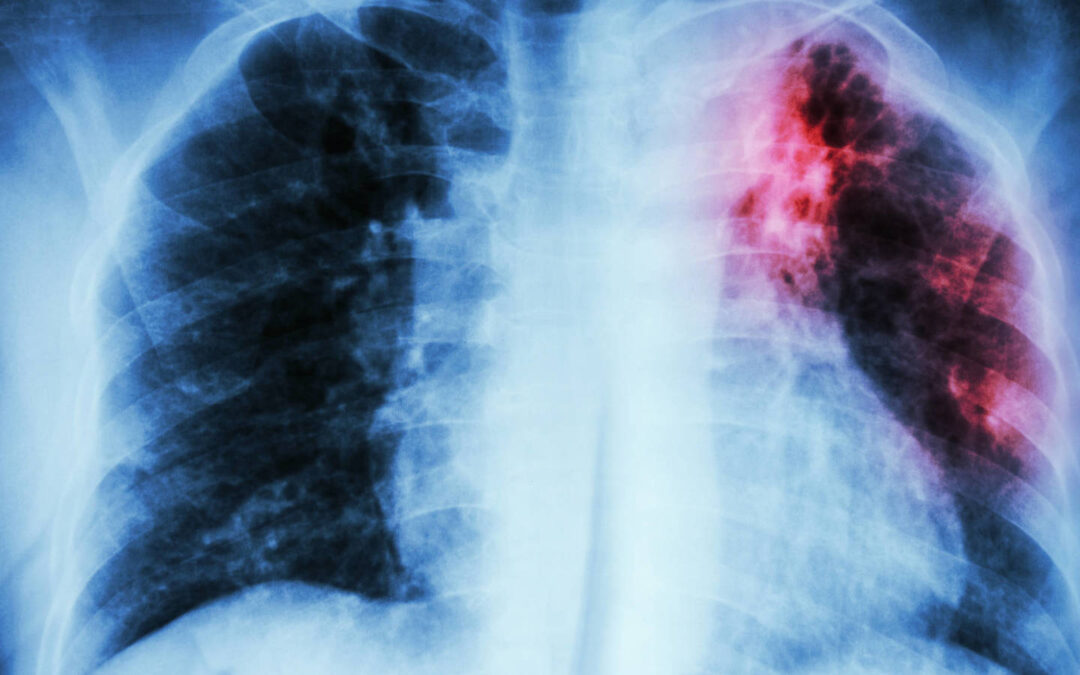 enfermedad pulmonar por amianto