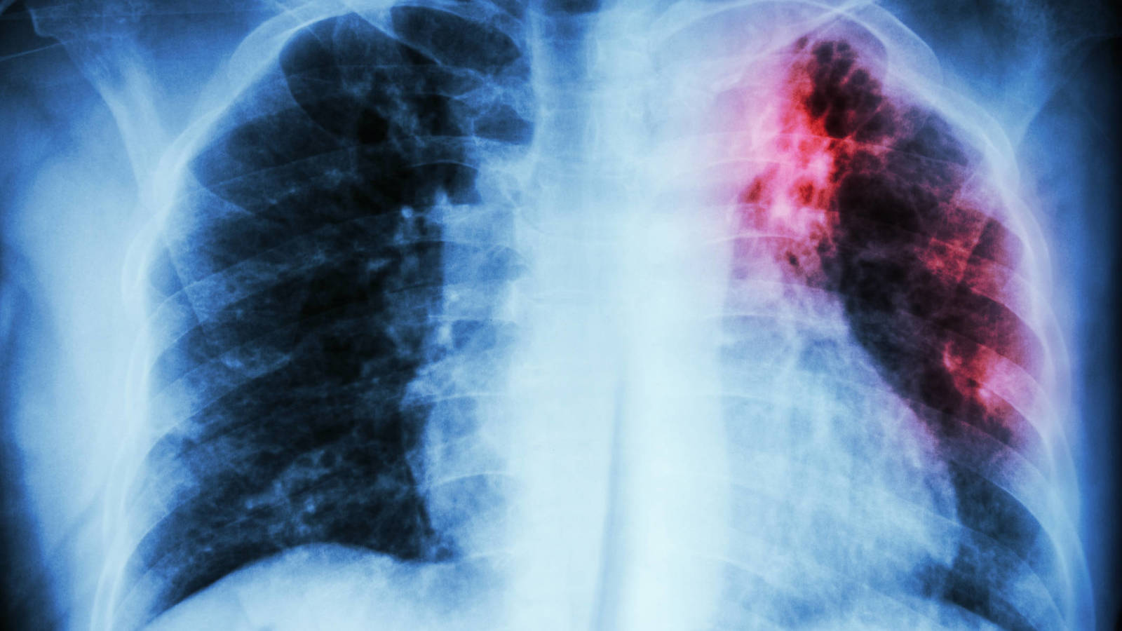 enfermedad pulmonar por amianto